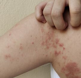 Deputados alertam para aumento de casos de hanseníase em MT